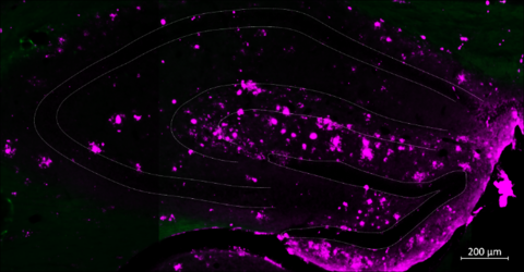 Plaquebildung (purpel) im Bereich des Hippocampus der neurogenen Nische mit endogenen Stammzellen (grün). 