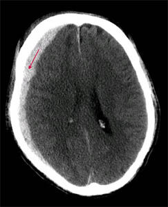 Subduralhamatom Subdurale Blutung