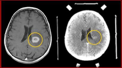 Lymphom