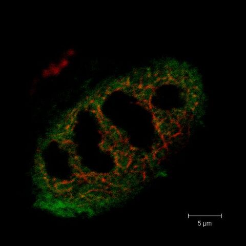 Abb 1: S100A11 (grün) und RAD51 (rot) kolokalisieren mit geschädigter DNA im Kern von HaCaT-Kerationozyten.