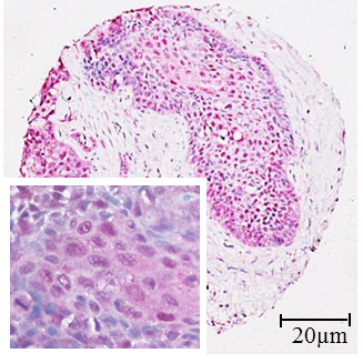 PITX1-Proteinexpression beim Lungenkrebs 