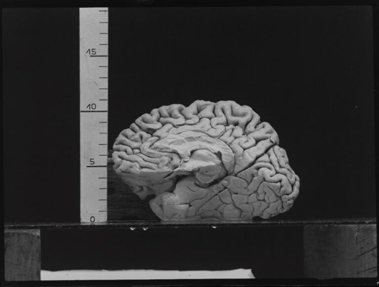 Rechte Großhirn-Hemisphäre von Ernst Haeckel, Innenseite. Glasplatten-Negativ (invertiert), Aufnahme 1921 durch die Firma Carl Zeiss unter Anleitung des Anatomen Friedrich Maurer. Anatomische Sammlung Jena, XMP 015.