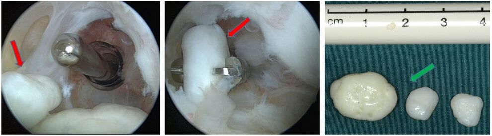 Freie Gelenkkörper bei der Arthroskopie (rote Pfeile) und nach Entfernung (grüner Pfeil)