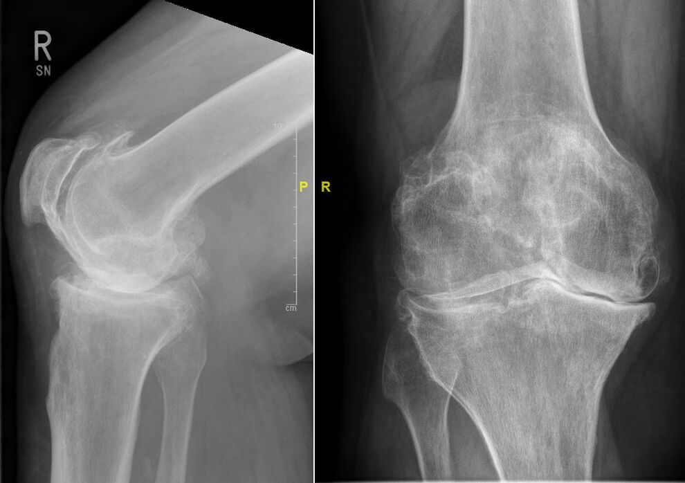 Röntgenbild einer fortgeschrittenen Gonarthrose