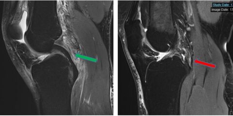 Intaktes hinteres Kreuzband (grüner Pfeile) hintere Kreuzbandruptur (roter Pfeil) (Bilder IDIR UKJ Jena)