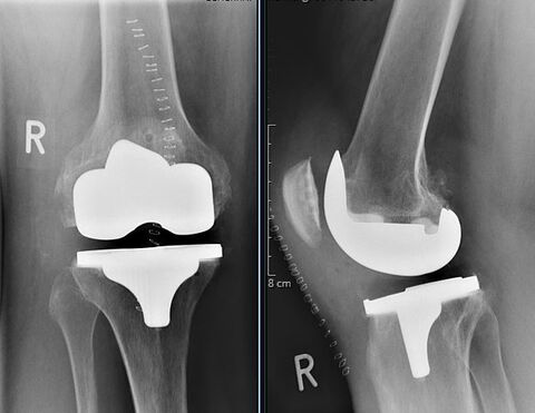 Vollständiger Ersatz des Kniegelenkes (= Totalendoprothese)