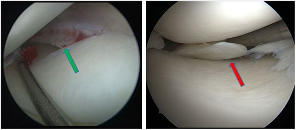 Traumatischer Meniskusriss (grüner Pfeil) degenerativer Meniskusriss (roter Pfeil)