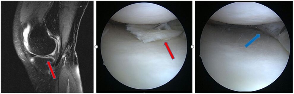 Degenerativer Innenmeniskusriss mit Einklemmung (roter Pfeil), nach Resektion (blauer Pfeil) 
(MRT-IDIR UKJ Jena)
