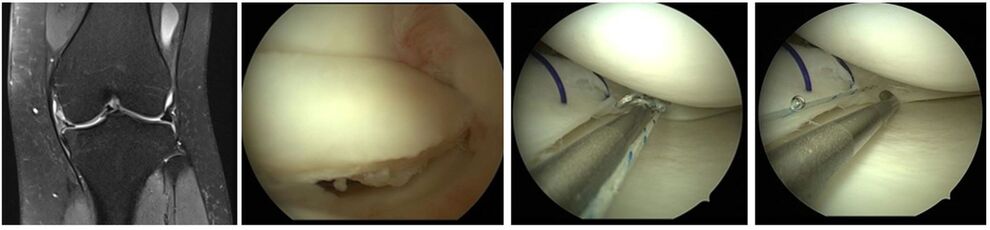 Traumatischer Korbhenkelriss Innenmeniskus mit Einklemmung, Refixation durch Naht und Nahtsystem 
(MRT IDIR UKJ Jena)
