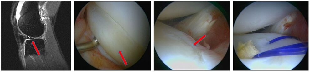 Traumatischer Korbhenkelriss Außenmeniskus mit Einklemmung, Reposition und Refixation durch Naht
(MRT IDIR UKJ Jena)
