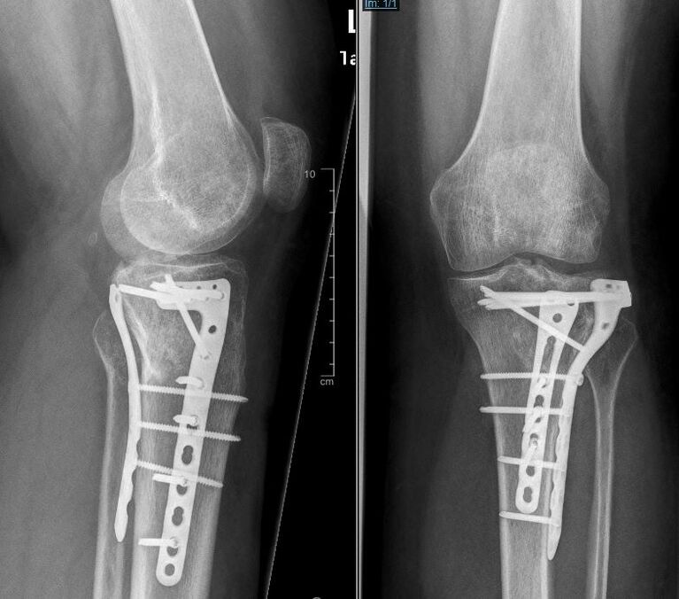 Mittels Doppelplattenosteosynthese versorgte Tibiakopffraktur