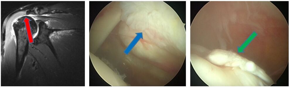 Ruptur im MRT (roter Pfeil) abgerissene Sehne (blauer Pfeil) Sehnenrest am Oberarmkopf (MRT IDIR des UKJ)
