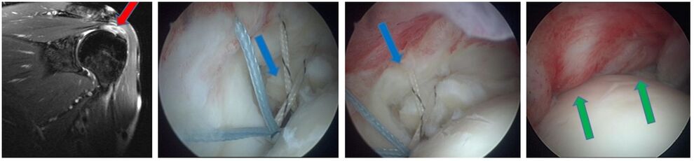 Ruptur im MRT (roter Pfeil), vorgelegte Nahtfäden (blaue Pfeile) refixierte Sehne (grüne Pfeile)
MRT IDIR des UKJ Jena
