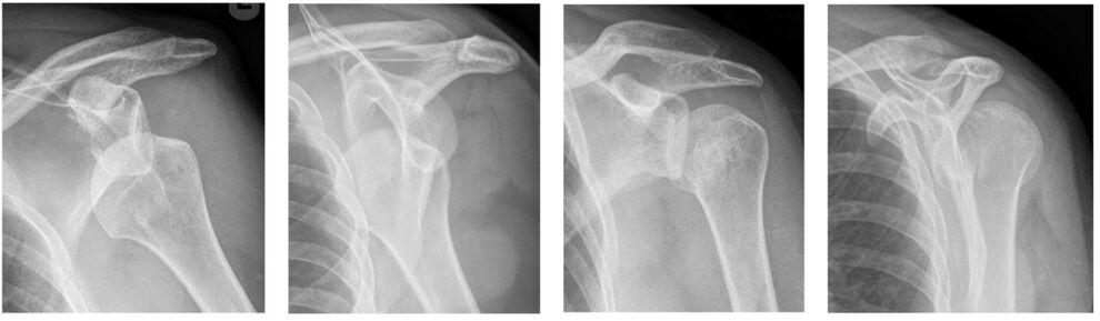 Vordere und hintere Schulterluxation (Bilder IDIR des UKJ Jena)