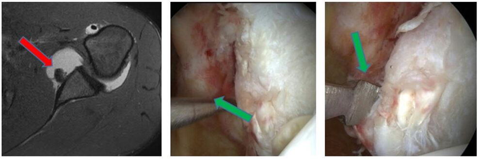 MRT-Bild einer Labrumverletzung (roter Pfeil), intraoperative Bilder der Verletzung (grüner Pfeil)
(MRT-Bild: IDIR des UKJ Jena)
