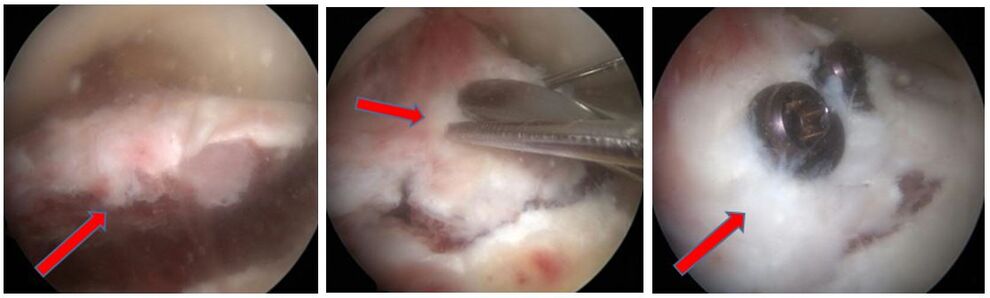 Arthroskopischer Befund, Reposition und Verschraubung