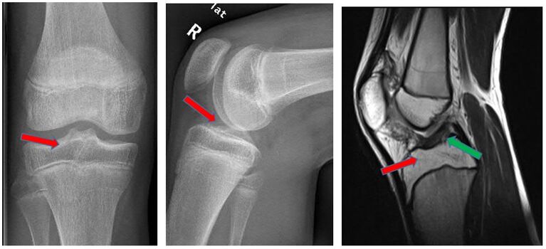 Röntgen- und MRT-Kontrolle nach Implantatentfernung (Bilder IDIR des UKJ Jena)
Roter Pfeil eingeheiltes Knochenfragment, Grüner Pfeil vorderes Kreuzband
