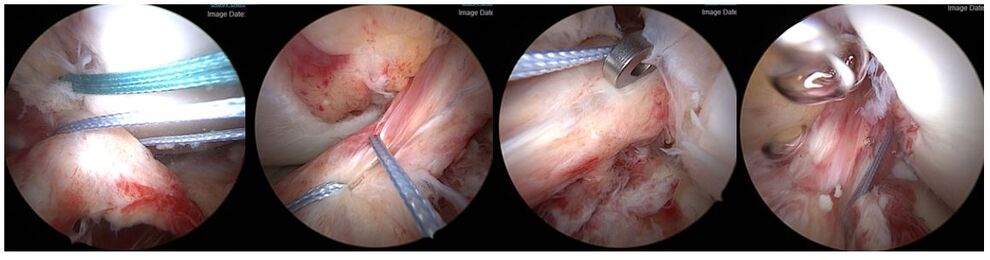  Beispiel für Kreuzbandnaht mit Fadenrefixation und Augmentation
