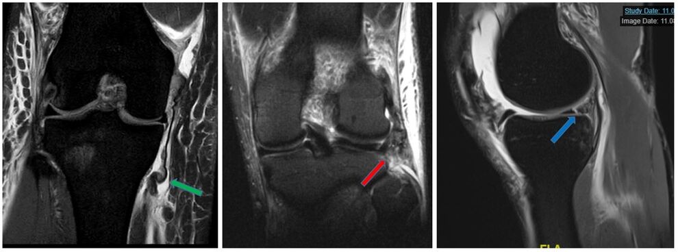 Innenbandruptur (grüner Pfeil), Außenbandruptur (roter Pfeil) Meniskusriss (blauer Pfeil (Bilder IDIR UKJ Jena)