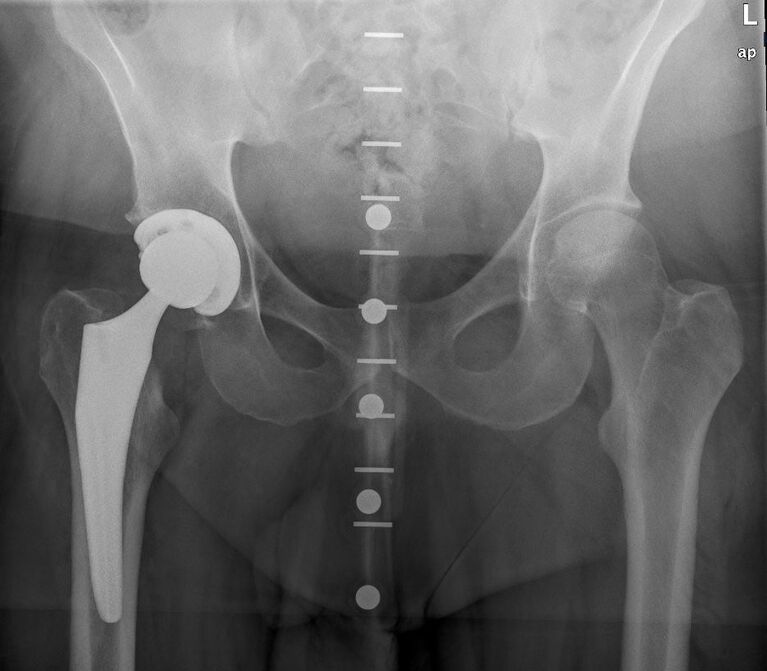 Zementfreie Hüfttotalendoprothese