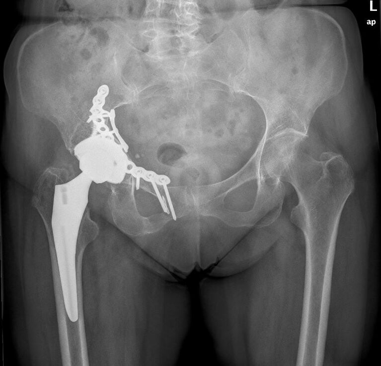 Zementfreie Hüfttotalendoprothese nach Azetabulumfraktur