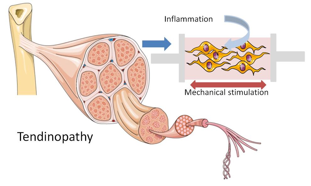 Analysis of factors influencing the biology of tenocytes isolated from different human tendinopathies.  
CC: smart.servier.com with modification
