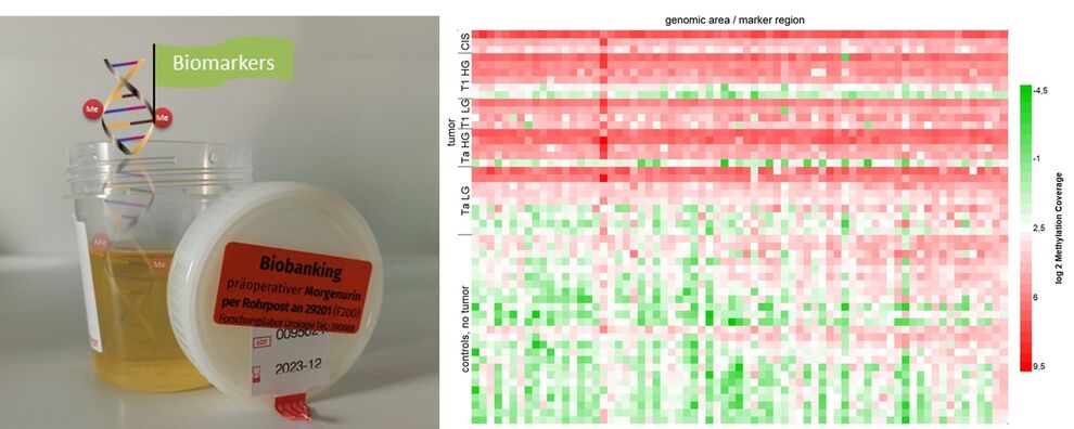 Abb. 2 Durch genomweites Screening mittels Sequenziertechniken können Biomarker im Urin für die Diagnostik des Harnblasenkarzinoms identifiziert werden.