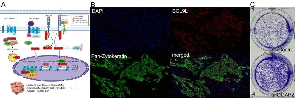 Abb. 1 Molekulare Mechanismen und Marker in der Progression des Urothelkarzinoms der Harnblase. (A) Einfluss von Mutationen auf den Wnt/beta-Catenin Signalweg. (B) Multiplex-Immunfluoreszenz von Tumorgewebe zur Markeranalyse. (C) Proliferations-Assay nach Knockdown eines Gens.